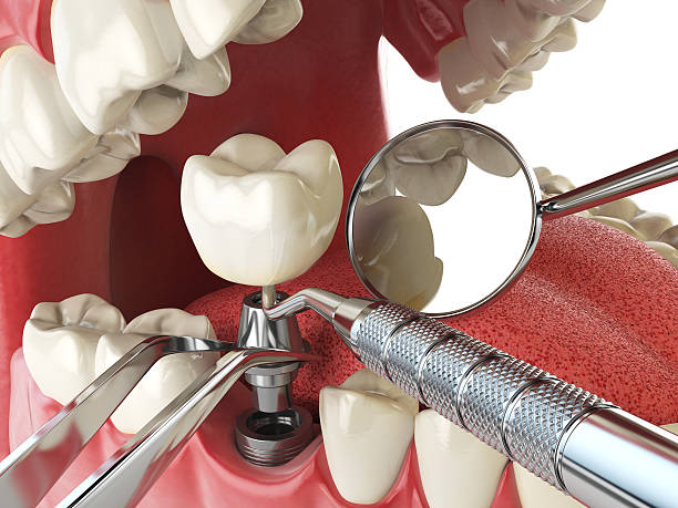 Best Emergency Root Canal Treatment in Eveleth, MN